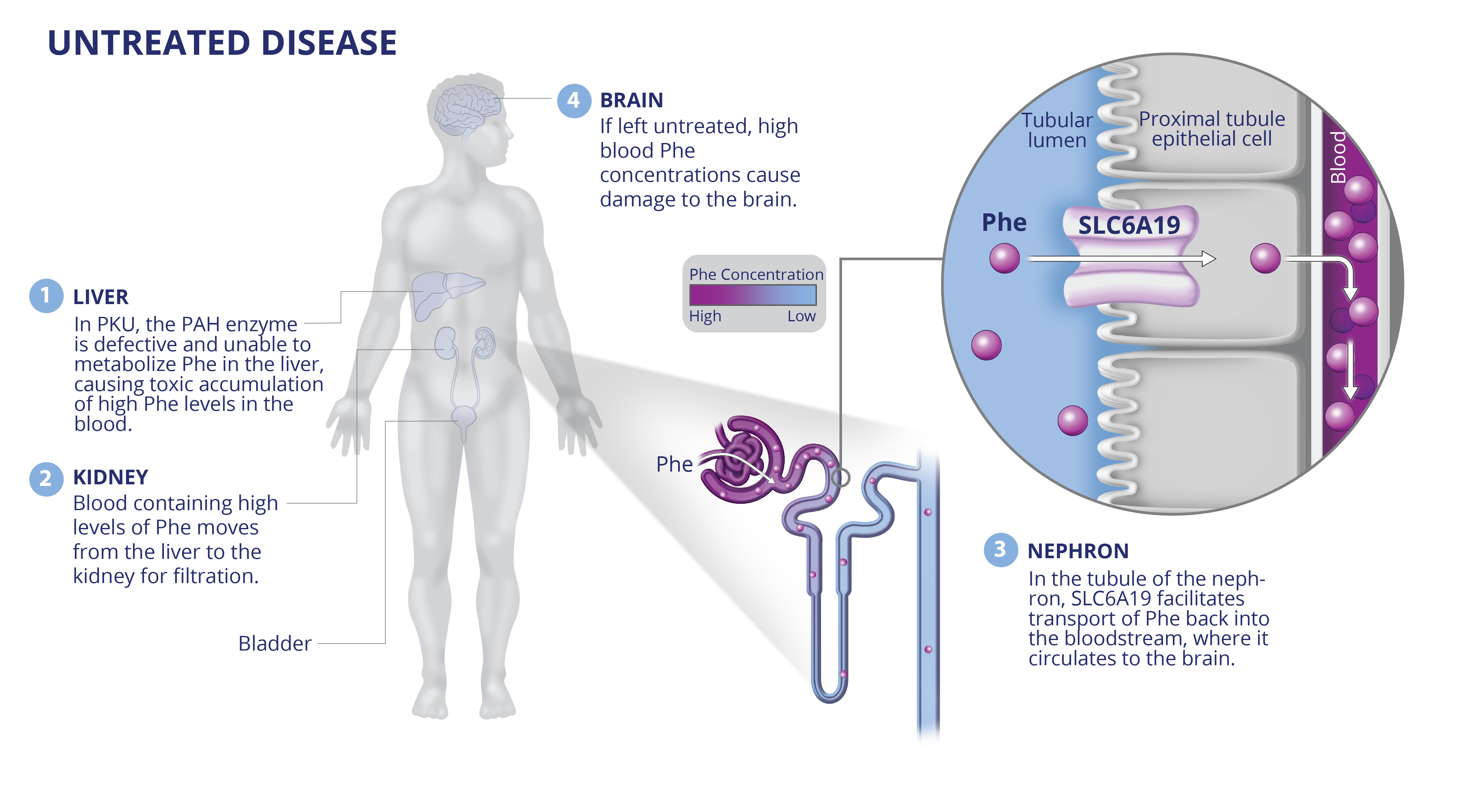 In untreated PKU phenylalanine cannot be metabolized resulting in high blood Phe levels that can cause damage to the brain.