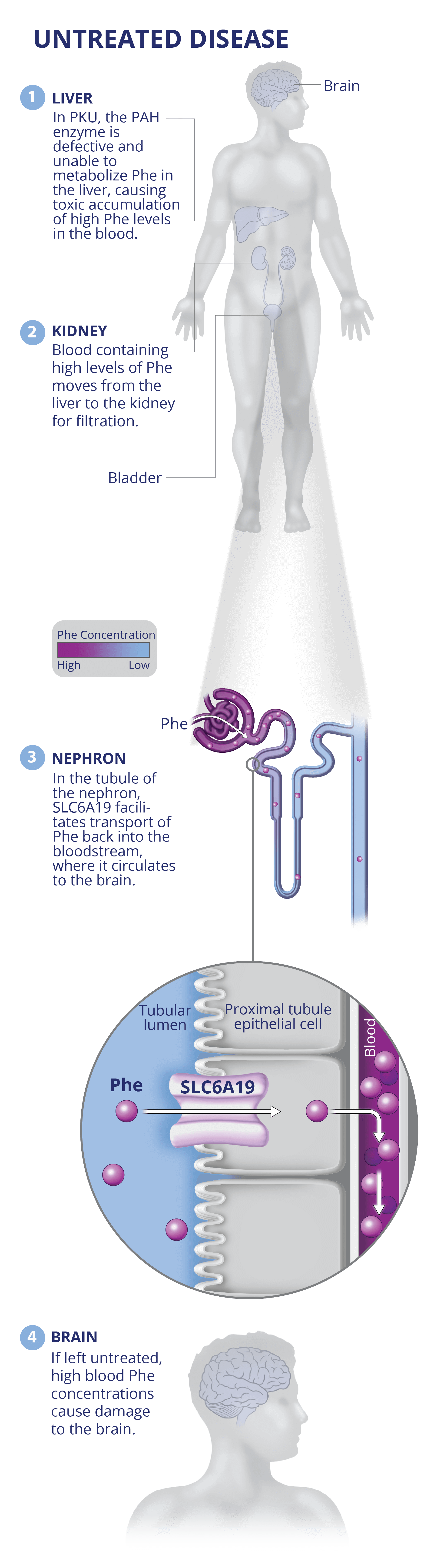 In untreated PKU phenylalanine cannot be metabolized resulting in high blood Phe levels that can cause damage to the brain